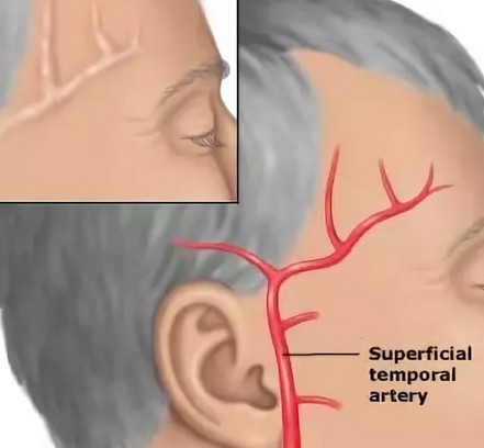 Почему может болеть голова в правом виске