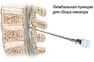 если после пункции болит спина